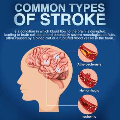 Stroke Program